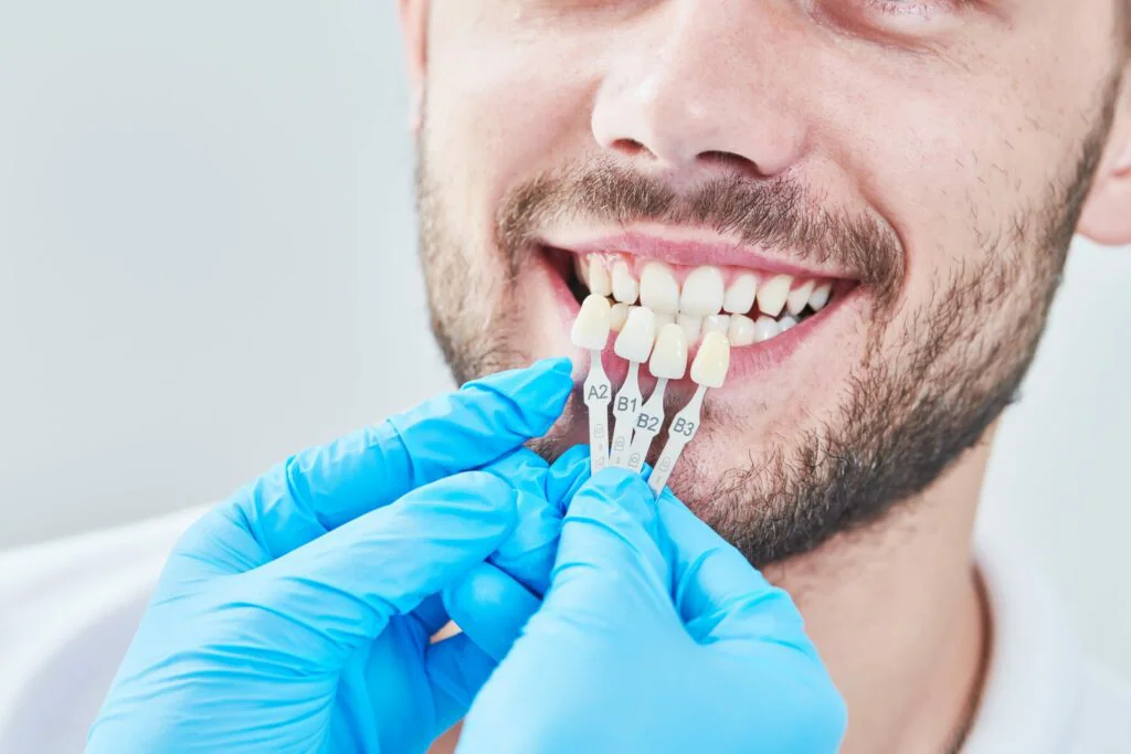 Veneers Ucd